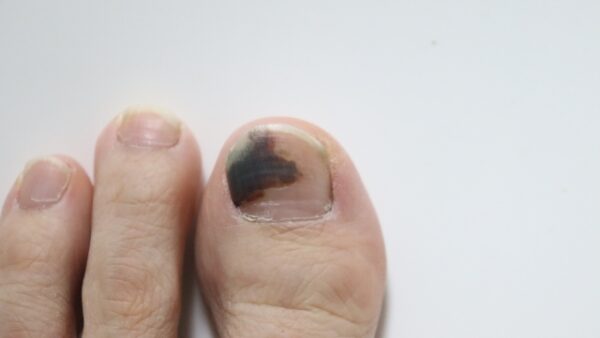 足の爪が黒い原因は？黒くならないための方法や対処法を解説！