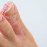 爪白癬（爪水虫）の原因と治し方は？予防策や似た症状「変形爪」を解説