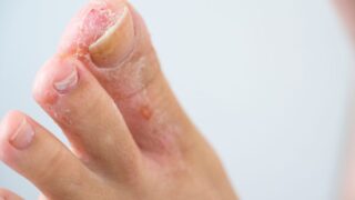 爪白癬（爪水虫）の原因と治し方は？予防策や似た症状「変形爪」を解説