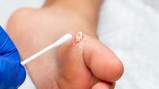 痛い魚の目の治し方は？自分でできる取り方と専門店治療の目安