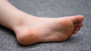 魚の目の原因は？改善すべき足元の習慣と再発防止のための予防策