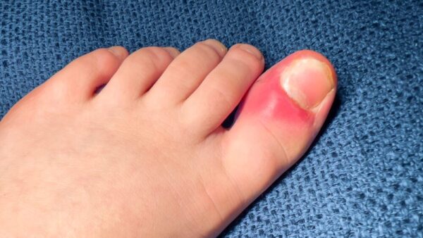 足の爪が伸びないのはなぜ？考えられる原因・症状と改善方法