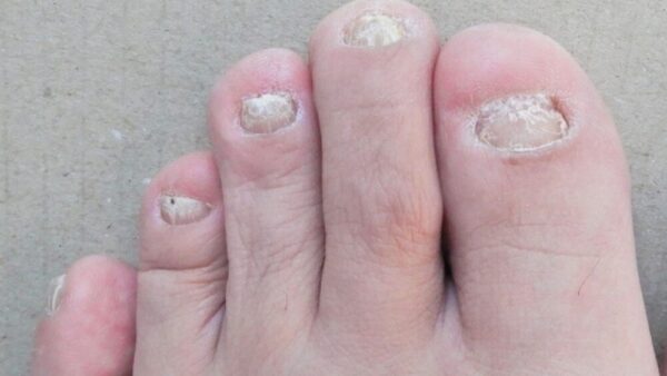 爪が白いのは病気？変形？考えられる原因と予防のための対処法