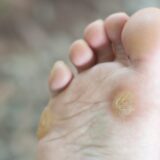 タコ（胼胝）の治し方と正しい予防法とは？魚の目との違いも解説