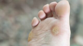 タコ（胼胝）の治し方と正しい予防法とは？魚の目との違いも解説