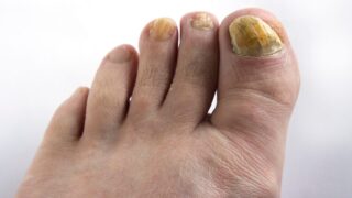 分厚い変形爪になる原因は？放置リスクとセルフケア・予防のコツ