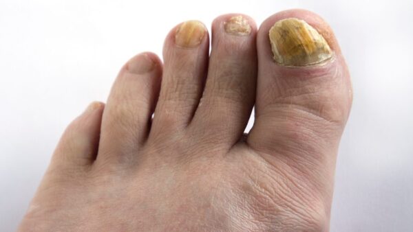 分厚い変形爪になる原因は？放置リスクとセルフケア・予防のコツ
