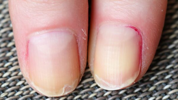 爪が2枚になる原因は？二枚爪や割れ爪、副爪のケアや改善方法を解説
