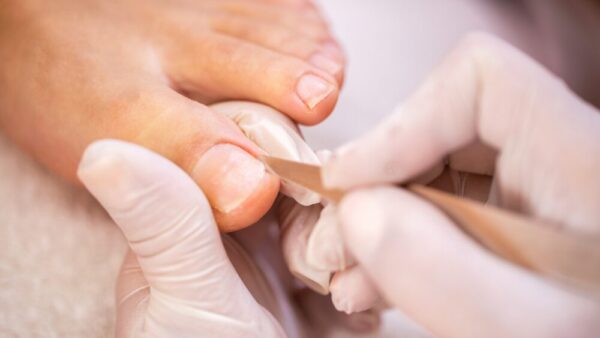 この巻き爪は軽度？重度？判断基準や治療方法について紹介