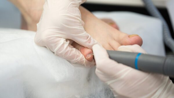 足の小指にできる副爪の治し方は？早めの対処で二次的なトラブルを防ごう