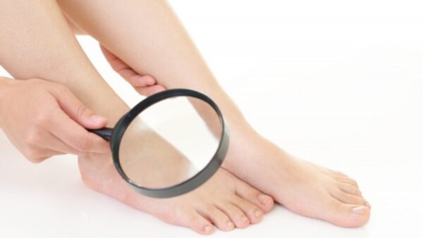 巻き爪の原因とは？なりやすい人の特徴や予防方法・対処法を解説