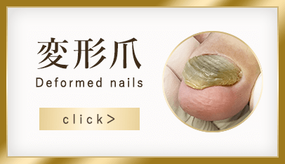 変形爪