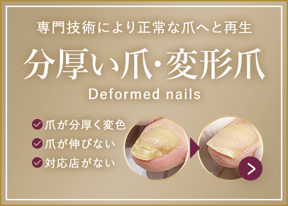 分厚い爪・変形爪