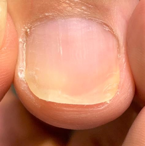 分厚い爪・変形爪・変色した爪・爪が伸びない施術後