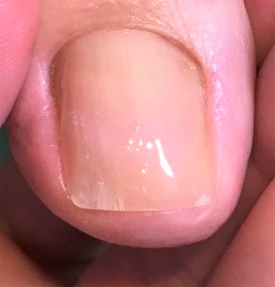 分厚い爪・変形爪・爪が伸びない・爪の表面がガタガタ施術後